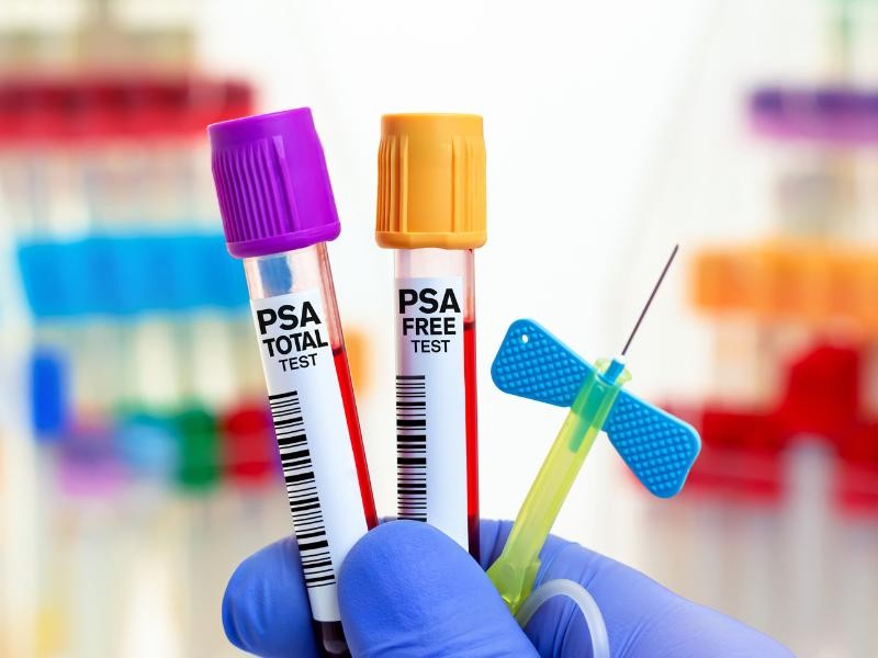 Exame de PSA: Para Que Serve e Qual a Idade Ideal para Começar a Fazer