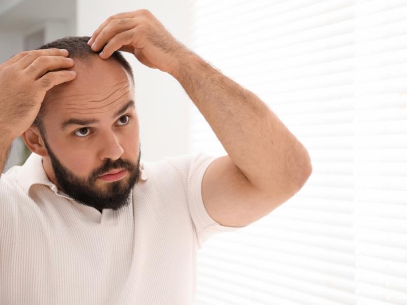 Calvície: Por Que Procurar um Dermatologista Especialista?