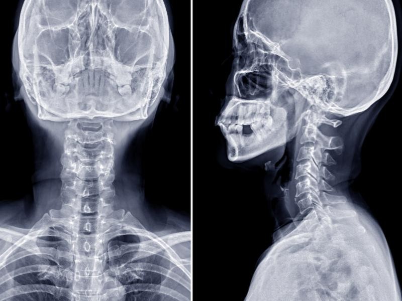 RX Coluna cervical 3 incidencias