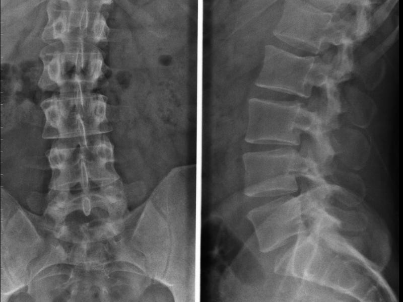 RX Coluna Dorso Lombar