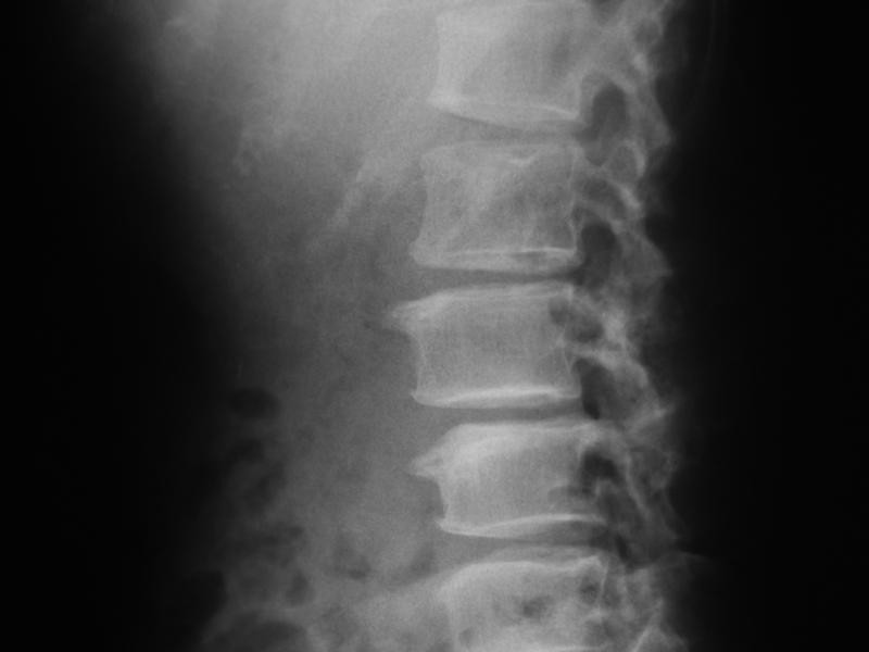 RX Coluna Lombar 3 Incidencias