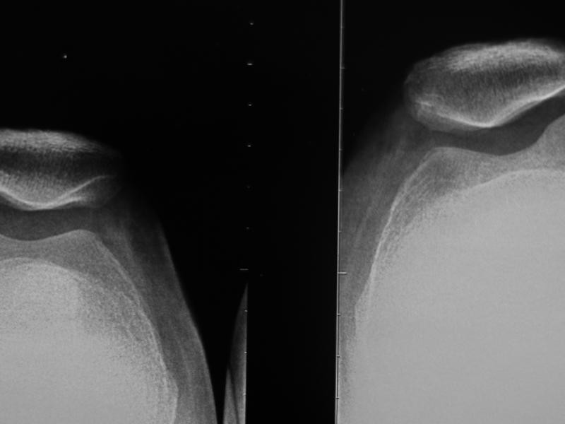 RX Axial de Patela Esquerdo