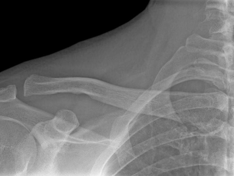 RX Articulação Acromioclavicular Direita