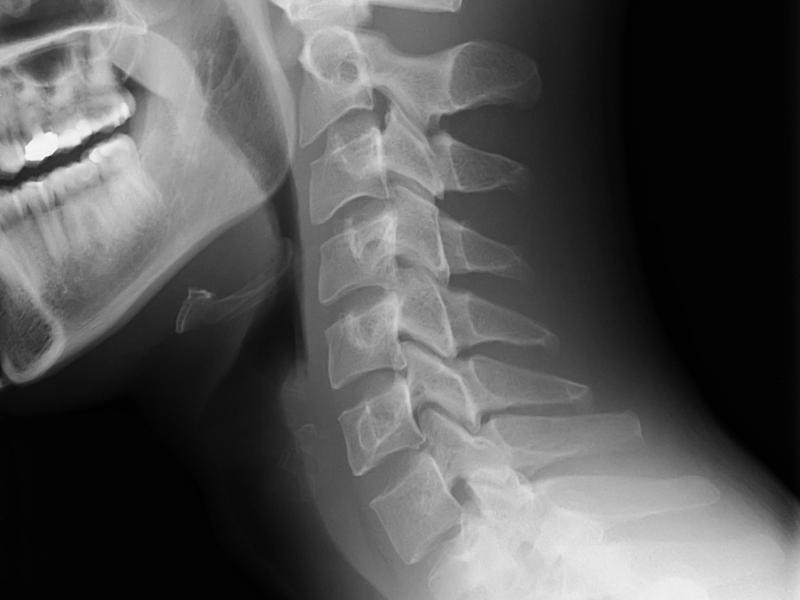 RX Coluna Cervical 5 Incidencias