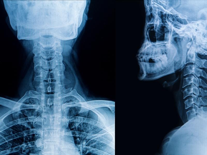 RX Coluna Cervical Funcional/dinâmica 7 Incidencias