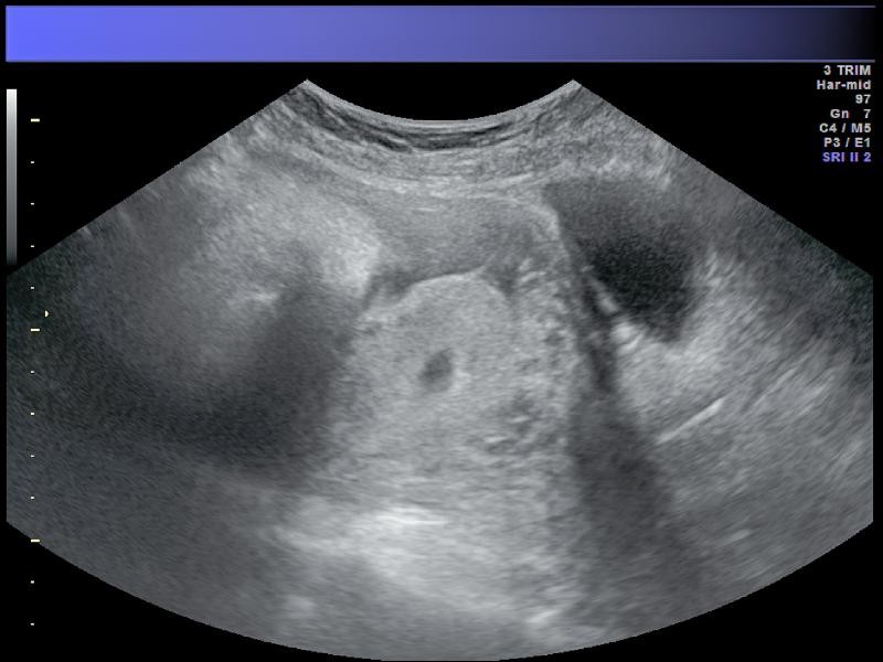 Ecografia Obstétrica Morfológica