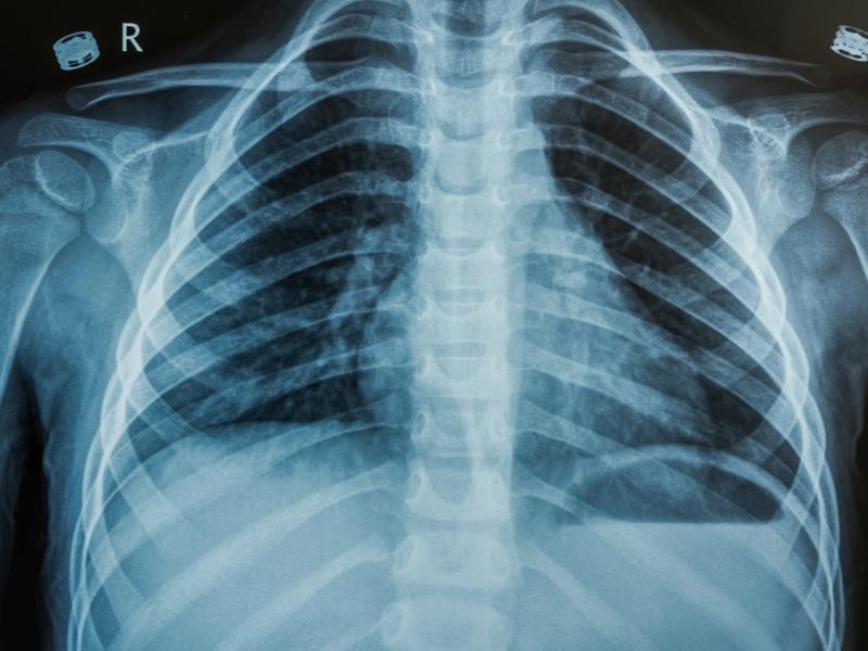 RX Incidência Adicional de Tórax