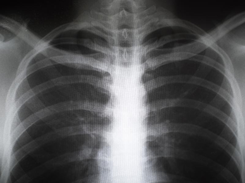 RX Articulação Esternoclavicular Direita