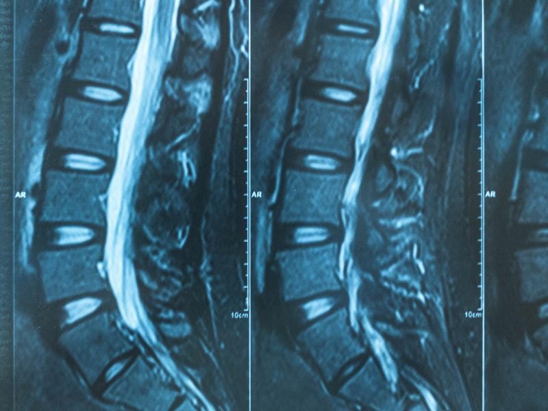 RX Coluna Lombo Sacra 5 Incidencias