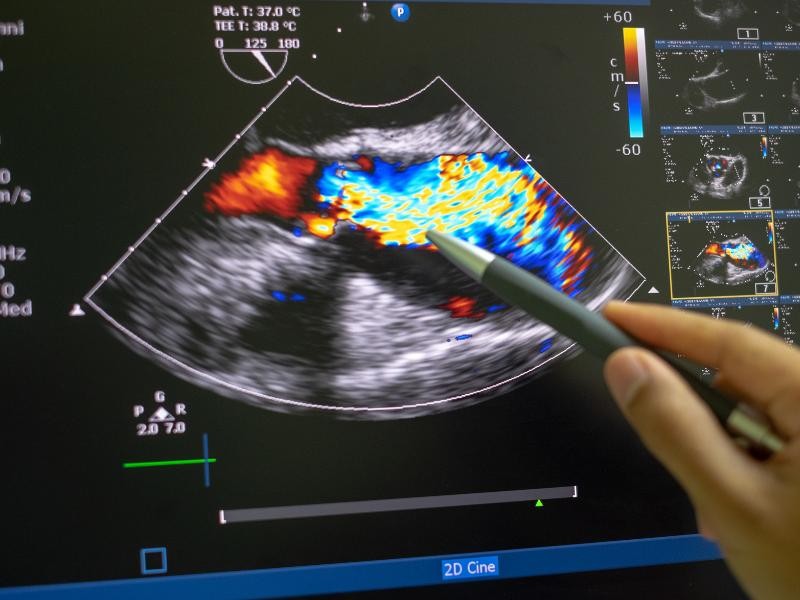 Ecodoppler de Aorta e Iliacas