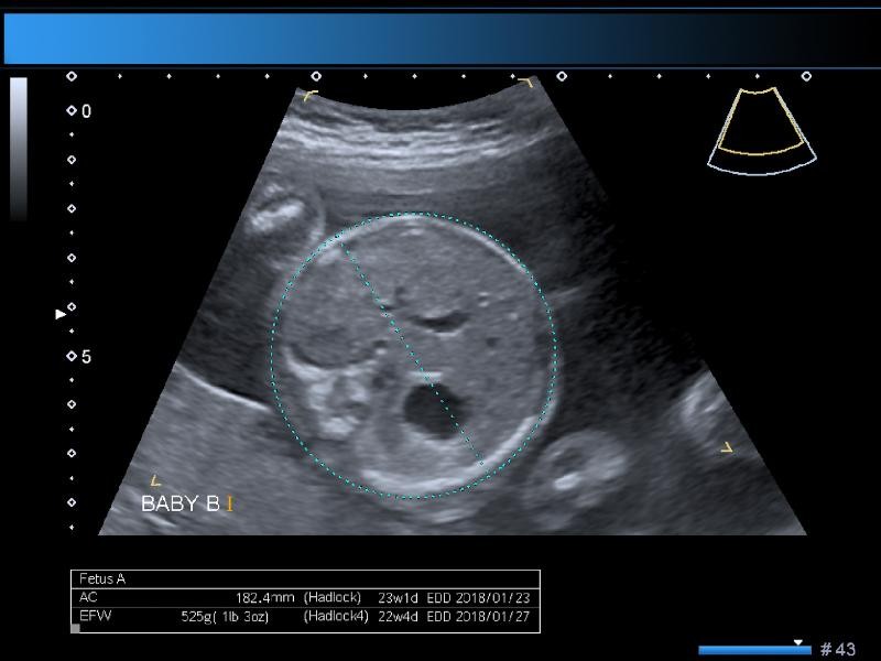 Ecografia Transvaginal Obstétrica Gemelar