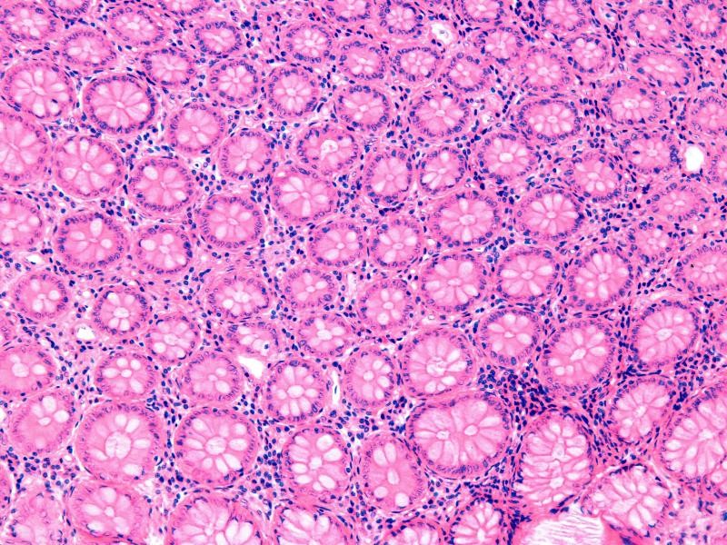 SHISTOSSOMA, PESQUISA OVOS EM FRAGMENTOS MUCOSA APOS BIO