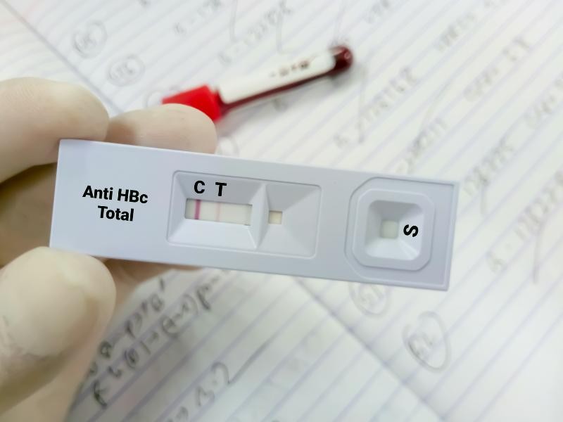 Hepatite B - Anti HBc IgM