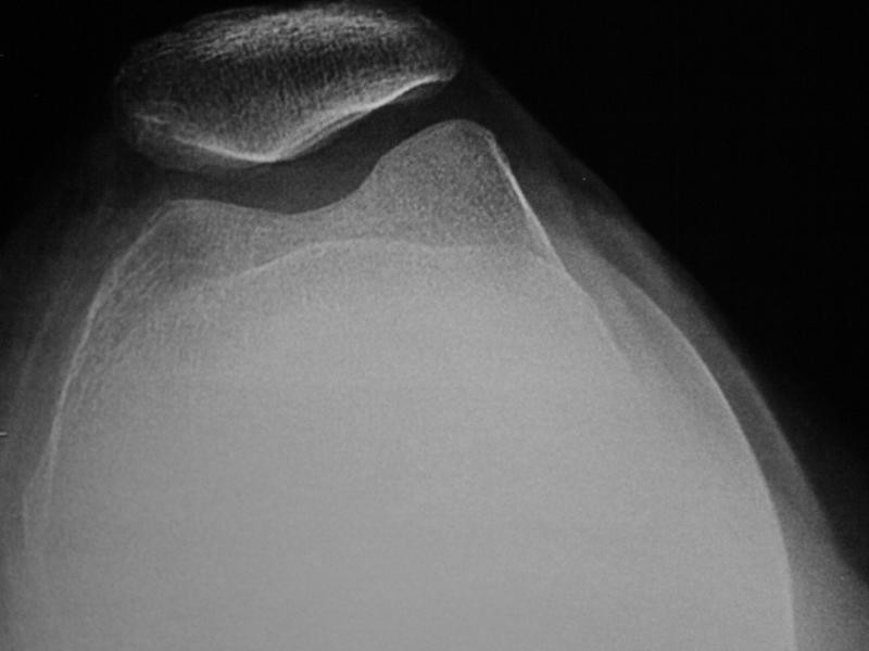 RX Axial de Patela Direita