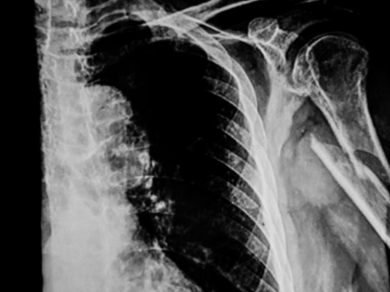 RX Articulação Esternoclavicular Esquerda